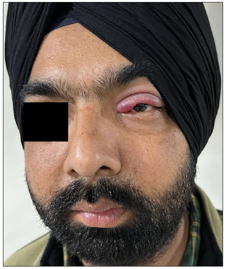 Edema and erythema over the left eyelid in a patient of IgG4 disease.