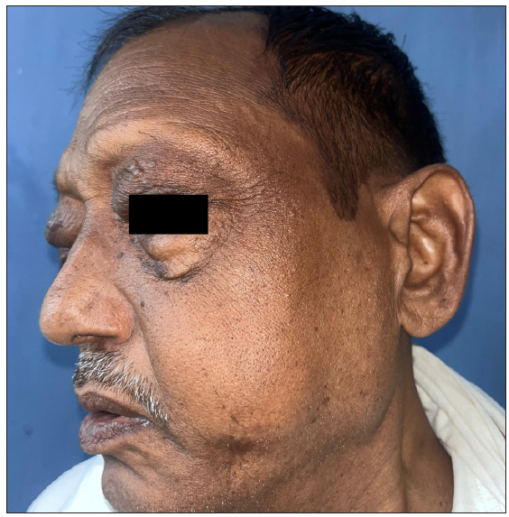 Swelling of eyelids and left cheek in a patient of IgG4 disease.