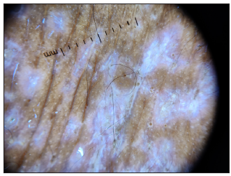 Dermoscopy (DL4, 10× magnification, polarised mode) of violaceous papules on the forearm revealed Wickham’s striae characterised by fine, whitish reticular lines.