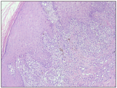 Section shows hyperkeratosis of the epidermis with interface dermatitis at the dermo-epidermal junction (Haematoxylin & eosin, 100x).