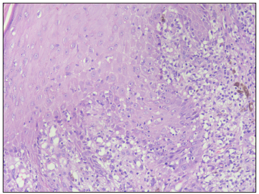 Basal cell vacuolation and lymphocytic infiltrate at the dermo-epidermal junction (Haematoxylin and eosin, 400x).