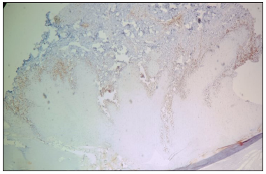 Positive immunohistochemical staining for CD3, highlighting the dermal infiltrate of T-lymphocytes (40x).