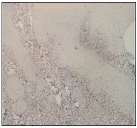 Negative immunohistochemical staining for CD20, indicating the absence of B-lymphocytes within the infiltrate (40x).