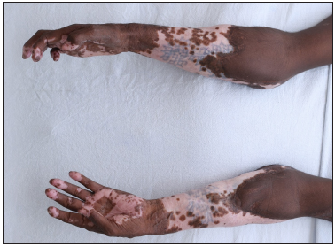 Resolution of the skin lesions following treatment with post inflammatory pigmentation.