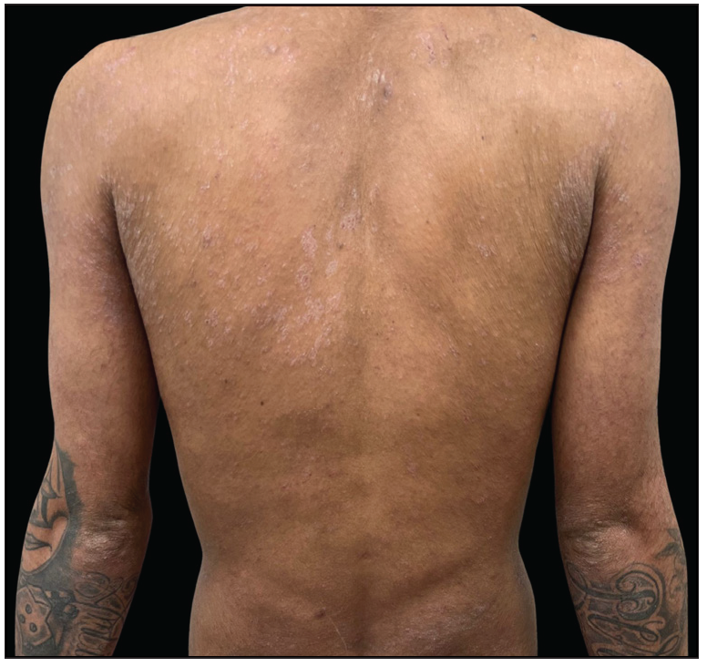 Disseminated erythematous crusted plaques on the back.