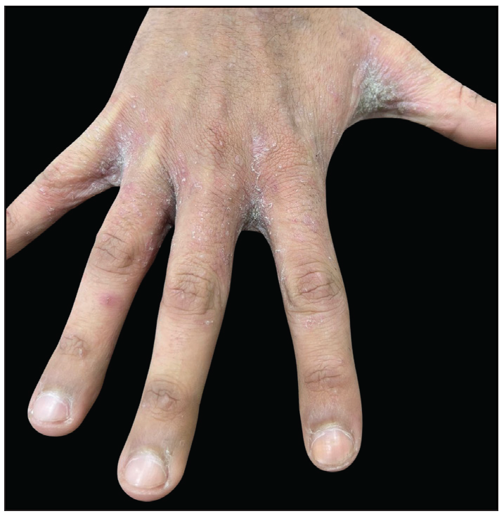 Erythematous crusted plaques in the interdigital region of the hands.