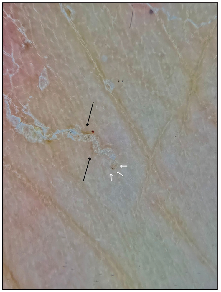 Presence of scabies/diplopoda-like tunnel (black arrows), as well as dark mite spots (white arrows). Polarised dermoscopy of palmar region of the hand, 10x with image amplification.