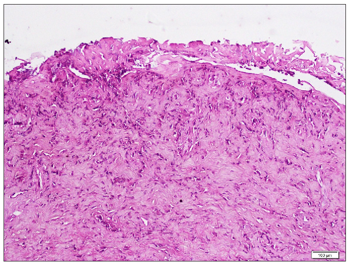 Epithelial ulceration associated with infiltration of the dermis consisting of neutrophils, lymphocytes, a few histiocytes and plasma cells, associated with a small-vessel vasculitis (Haematoxylin and eosin, 100x).