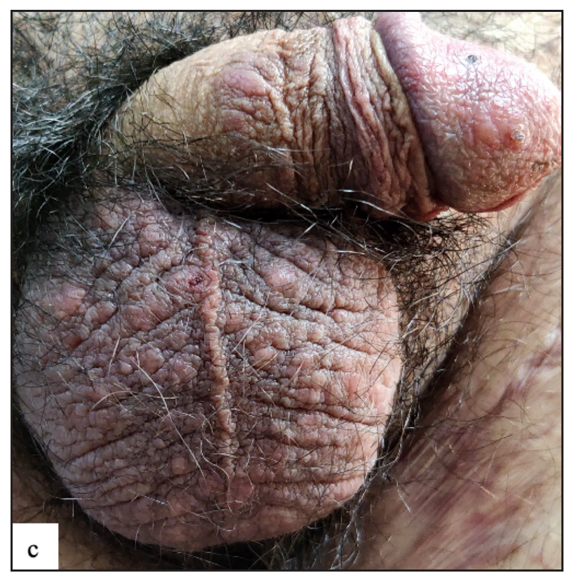 Various lesions of genital scabies. Numerous scattered erythematous papules over genitalia.