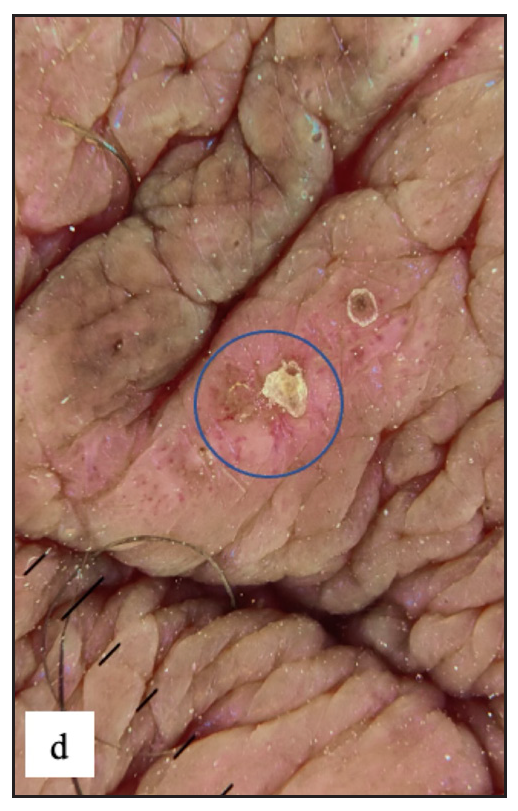 Dermoscopy revealed red structureless areas, dotted vessels and white-yellow scales (blue circle).