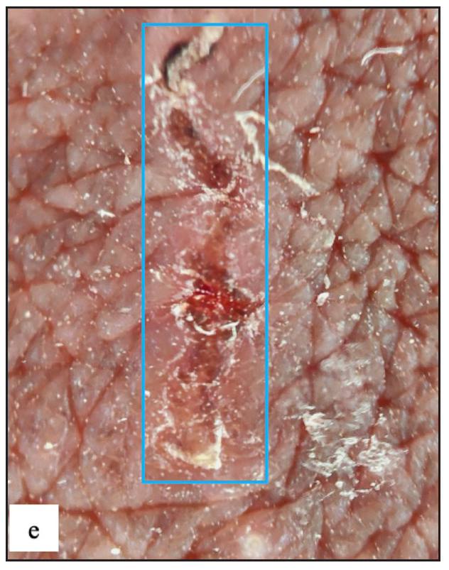 Serpiginous tract with haemorrhagic crusts and peripheral scales was seen in dermoscopy of burrows (blue square).