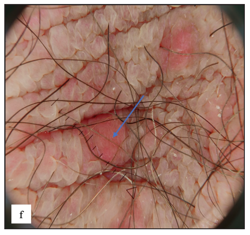 Scabetic nodules dermoscopy showed red structureless areas (blue arrow).