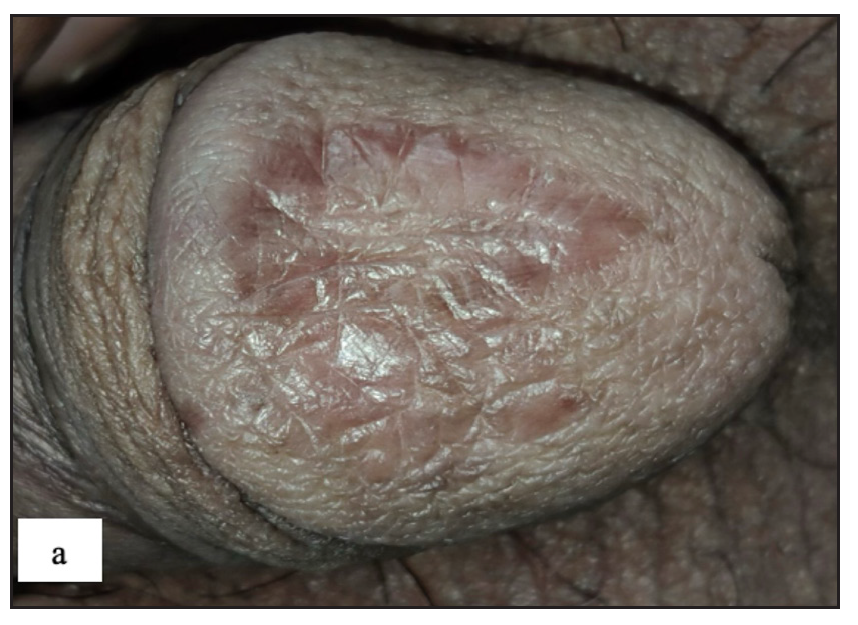 Genital psoriasis presenting with well-defined erythematous plaque over the glans penis.