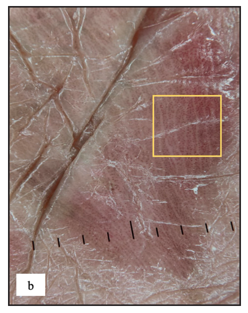 Regularly arranged dotted vessels over erythematous background in dermoscopy of genital psoriasis (yellow square).