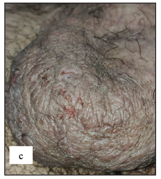 Lichen simplex chronicus showing massive lichenified plaque over the scrotum.