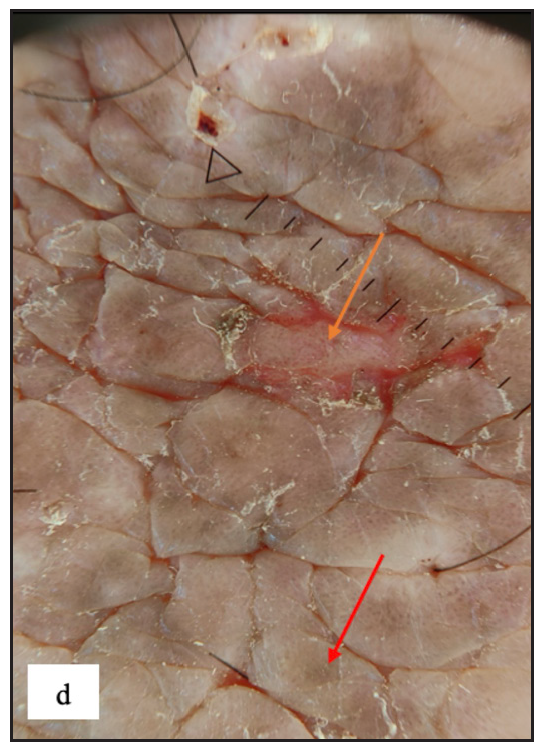 Dermoscopy depicting increased rugosity mimicking sulci and gyri along with brown dots (red arrow) and erosion (orange arrow) in lichen simplex chronicus.