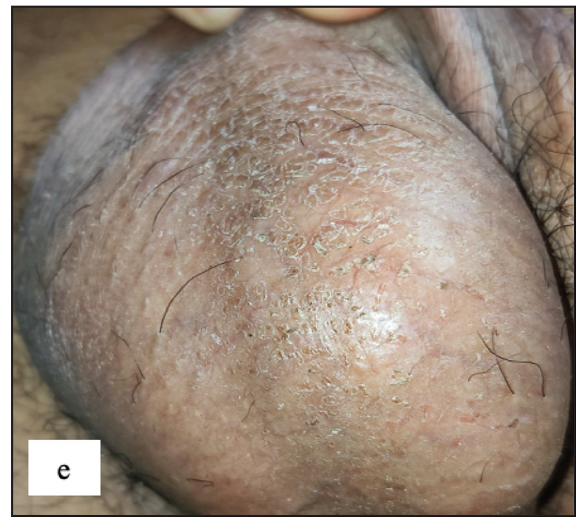 Scrotal dermatitis characterised by ill-defined oozy erythematous plaque with yellowish crusting and scaling over the scrotum.