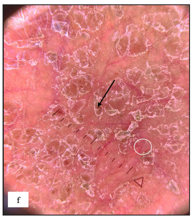 Irregularly arranged dotted vessels (white circle) with telangiectasia, background erythema and yellowish-brown scales (black arrow) were noted on dermoscopy of scrotal dermatitis.