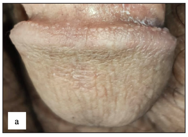 Pearly penile papule presenting as 1–2 mm pearly white coloured dome-shaped translucent papules over the coronal sulcus.