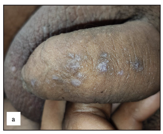 Various morphologies of genital lichen planus. Multiple well-defined violaceous flat-topped papules were present over the penile shaft in genital lichen planus.