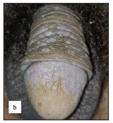 Well-defined violaceous papuloplaques were present over the penile shaft and glans penis.