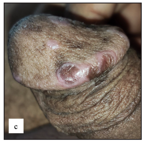 Well-defined annular violaceous plaques with central hyperpigmented macules and atrophy over the glans.