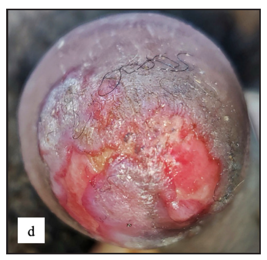 Erosive lichen planus was found as well-defined erosions with a yellowish crust over a violaceous plaque in the glans penis.