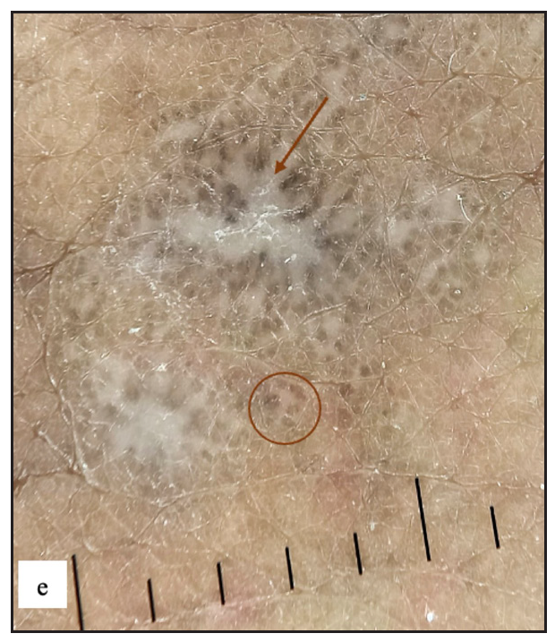 Dermoscopy showed grey structureless areas with radiating streaks (brown arrow) and brown dots (brown circle).