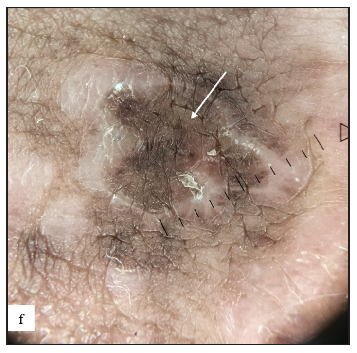 On dermoscopy, annular lichen planus were characterised by grey coloured peripheral rim with central brown structureless areas, dots and globules (white arrow).