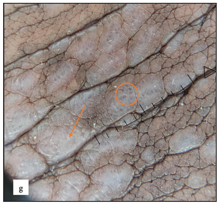 Purple structureless areas (orange arrow) with blue-brown dots (orange circle) were noted in dermoscopy.