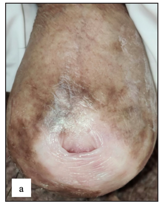 Lichen sclerosus characterised by a well-defined porcelain white atrophic plaque with a ‘pinhole’ meatus.