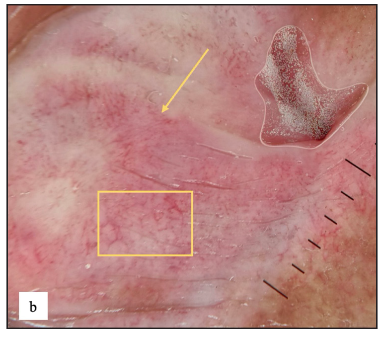 White structureless areas with pinkish background erythema (yellow arrow) and linear, dotted and curved vessels (yellow square) on dermoscopy of lichen sclerosus.