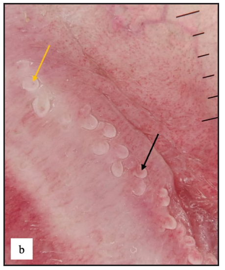 Dermoscopy of pearly penile papules showed white cobblestone appearance with central comma-shaped vessels (black arrow) and brown dots (yellow arrow).