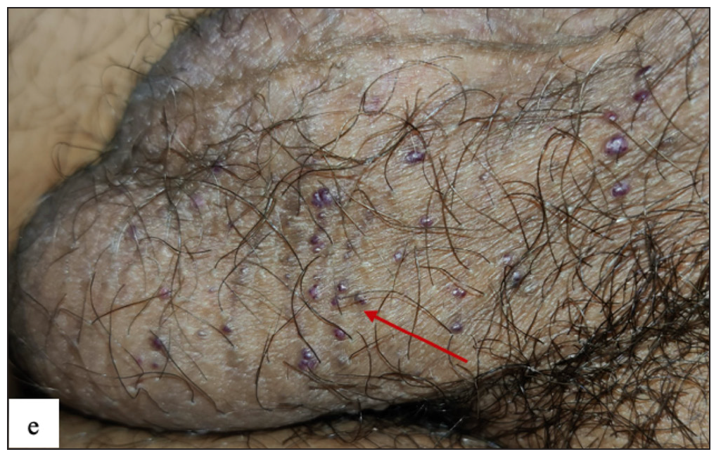 Multiple discrete dusky blue keratotic papules (red arrow) were present over the scrotum in Angiokeratoma of Fordyce.