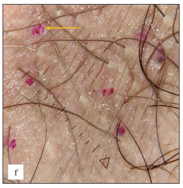 Red lacunae with blue-white veils (yellow arrow) were observed in dermoscopy of Angiokeratoma of fordyce.