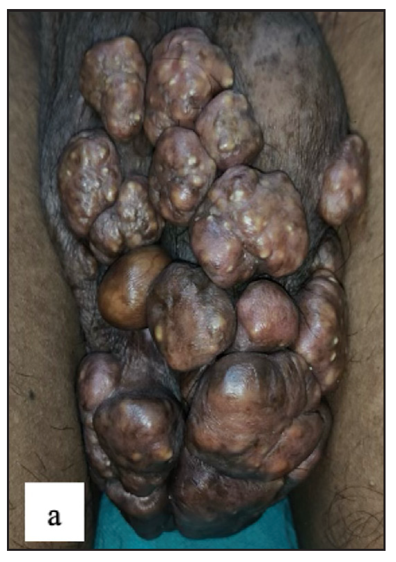 Idiopathic scrotal calcinosis showed multiple firm skin-coloured to hyperpigmented swellings with yellowish discolouration over the scrotum.