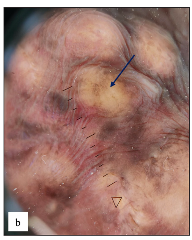 Dermoscopy of idiopathic scrotal calcinosis revealed yellow globules and structureless areas (purple arrow), brown dots, peripheral brown areas and blurry vessels