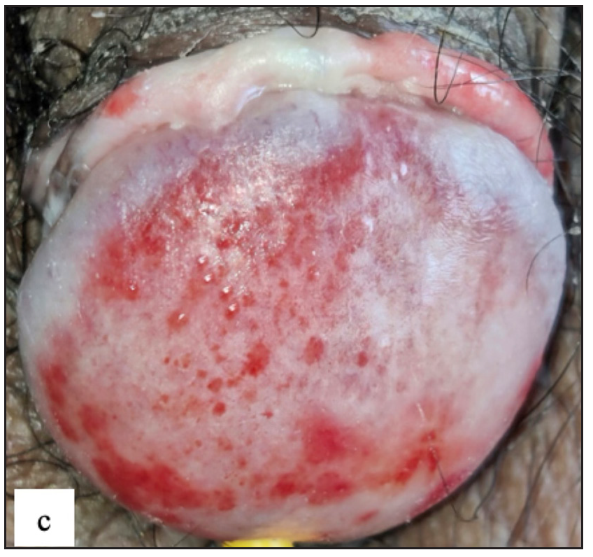 Zoon’s balanitis characterised by multiple, well-defined, moist, glistening bright red macules over the glans penis and the prepuce.