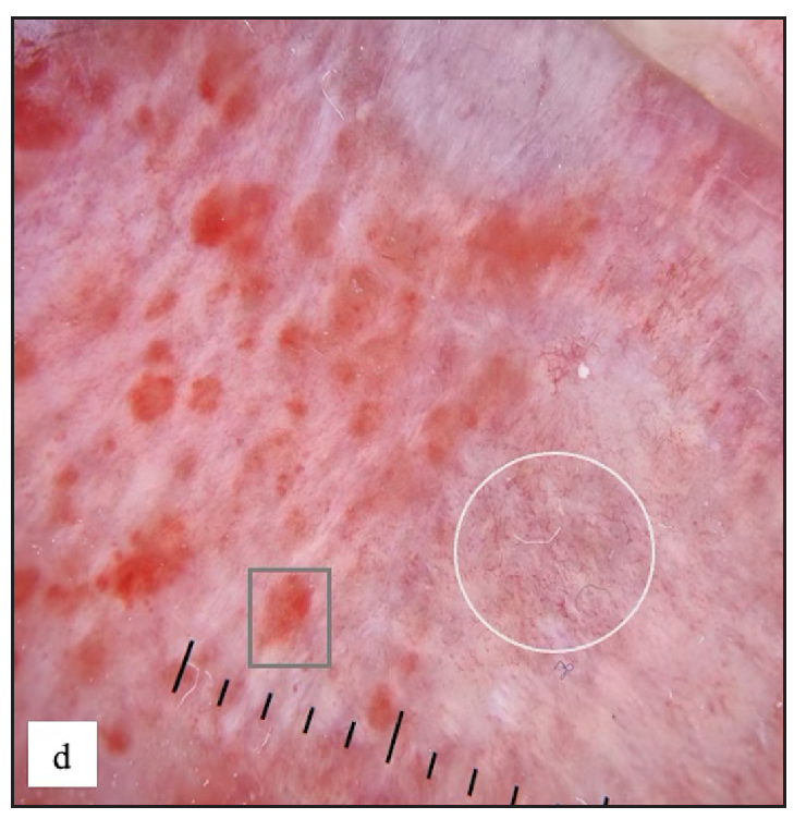 Zoon’s balanitis Dermoscopy showed reddish orange structureless areas, globules (grey square) and dotted, curved, linear and serpentine vessels (white circle).