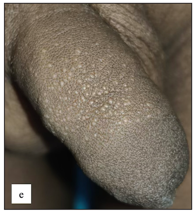 Lichen nitidus typified by multiple discrete shiny hypopigmented pinhead-sized grouped papules over the penile shaft.