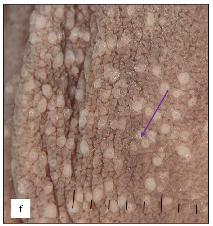 Lichen nitidus dermoscopy revealed white structureless areas with central brown shadow (purple arrow).