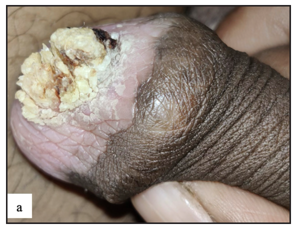 Pseudoepitheliomatous keratotic and micaceous balanitis was seen as whitish yellow hyperkeratosis with underlying whitish pink indurated plaque over glans penis.