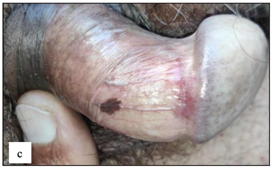 Genital melanosis characterised by well-defined brown to black coloured round macule over penile shaft.