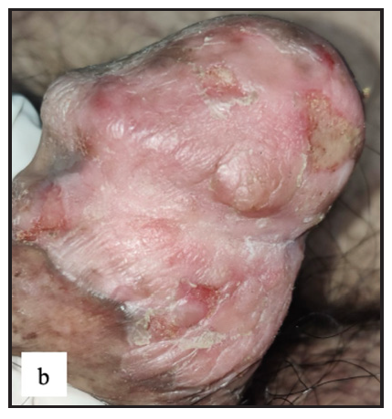 Well-defined erythematous indurated plaque with multiple ulcers and yellowish slough in Bowen’s disease over glans penis.