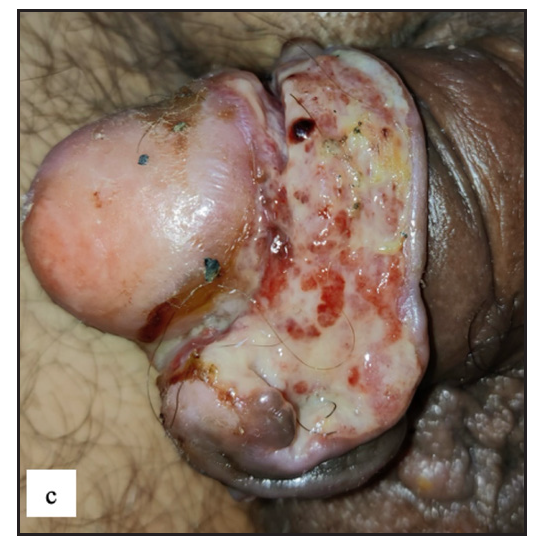 Well-defined firm to hard exophytic mass with ulceration, discharge and haemorrhage in coronal sulcus in penile squamous cell carcinoma.