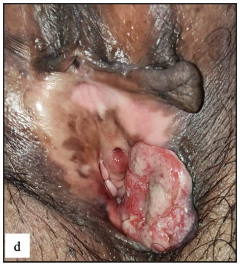 Round exophytic mass overlying lichen sclerosus in left labia majora in vulval squamous cell carcinoma.