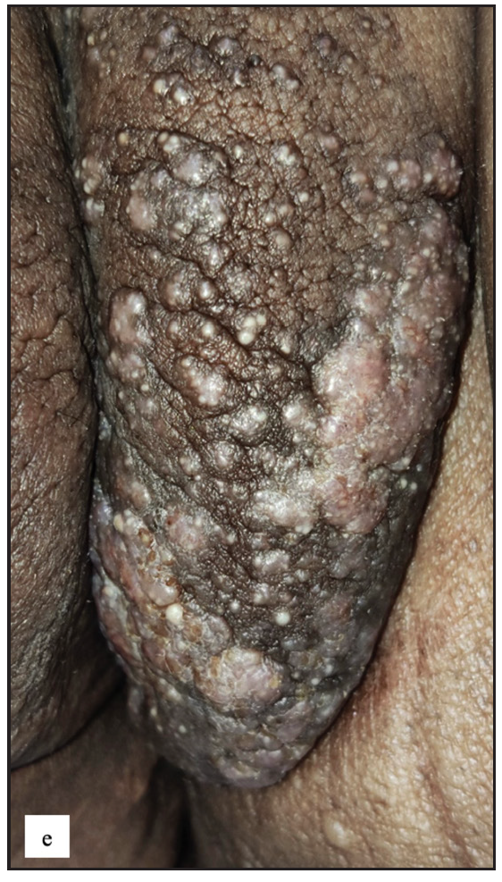 Left labia majora showing cutaneous metastasis with dystrophic calcification and lymphedema in a case of left CA ovary.