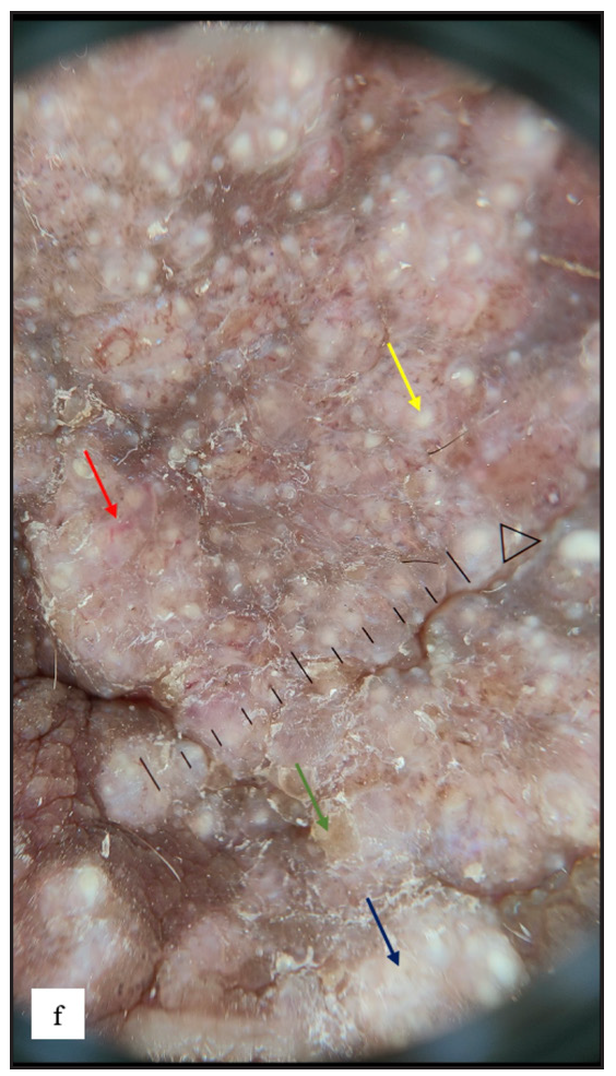 Dermoscopy of cutaneous metastasis revealed pinkish white structureless areas (blue arrow), yellow scales (green arrow), scattered yellow globules (yellow arrow) and curved vessels (red arrow).