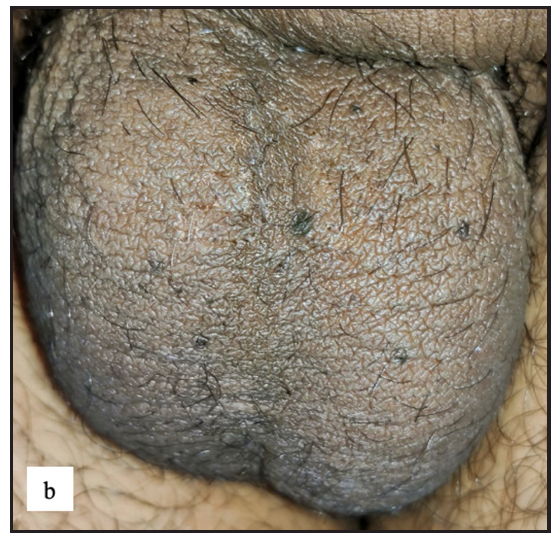 Multiple discrete hyperpigmented papules with raised keratotic rim over scrotum in genital porokeratosis.