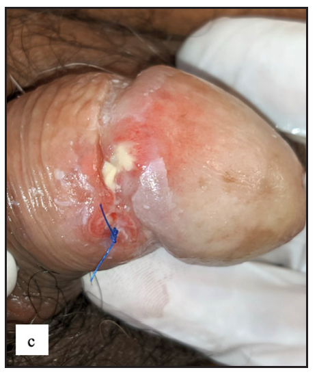 Indurated painful ulcer with yellowish slough over coronal sulcus in penile mucormycosis.